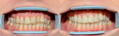 Фото до и после: лечение глубокого кариеса под микроскопом - Happy Dents