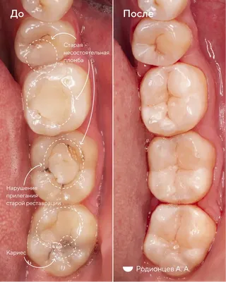 Лечение кариеса, фото до и после, пример работы 44107