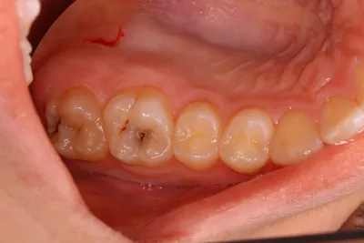 До и после. Развитие кариеса. Как остановить разрушение зубов. | Советы  стоматолога | Дзен