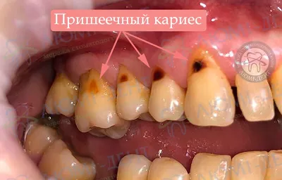 Лечение глубокого кариеса на жевательном зубе: выполненная работа с фото до  и после в стоматологии OneDent