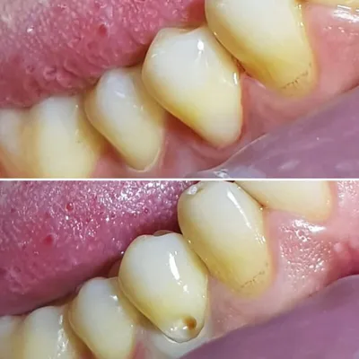 До и после. Развитие кариеса. Как остановить разрушение зубов. | Советы  стоматолога | Дзен