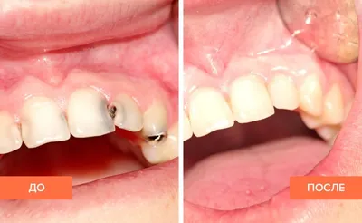 Вторичный кариес, 36 зуб | Примеры работ - фото до и после