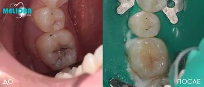 Пришеечный кариес фото, как лечить, причины возникновения | Dental Art