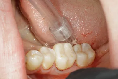Лечение кариеса зуба 2.6 фото до и после Мытищи — Мытищи цена и отзывы  стоматологии Best Family