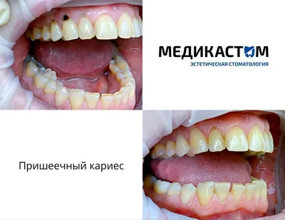 Фото до и после: лечение контактного кариеса на передних зубах - Happy Dents