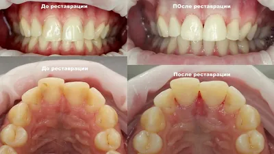 Результаты лечения в Клинике Полный Порядок: пример скрытого кариеса на 1.2  из-за скученности