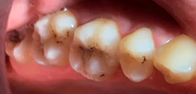 Лечение вторичного кариеса фото до и после Мытищи — Мытищи цена и отзывы  стоматологии Best Family