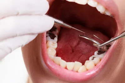 Почему появляется кариес на зубах? | «Стоматология на Пролетарской»