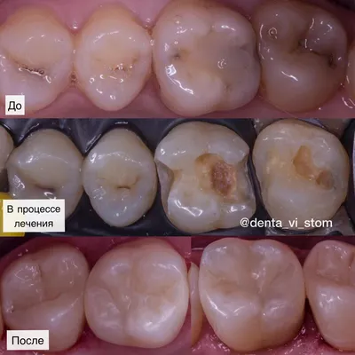 Кариес передних зубов – лечение перед установкой брекетов