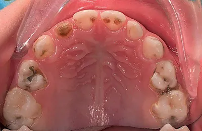 Фото до и после: лечение контактного кариеса на передних зубах - Happy Dents