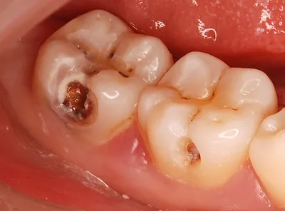 Лечение среднего и глубокого кариеса на жевательных зубах - Омега Стом
