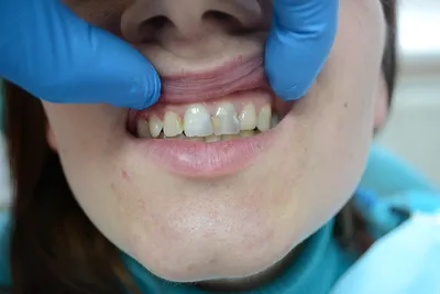 Лечение кариеса в стоматологии Подольск | Стоматология Улыбка