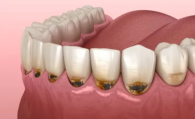 Начальный и поверхностный кариес: симптомы и методы лечения зубов