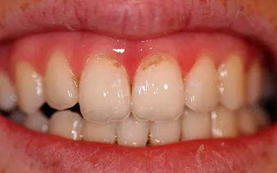 Лечение кариеса зубов 24,25,26 - Студия Улыбок