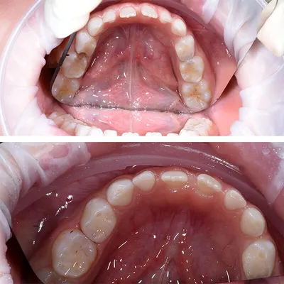 Нужно ли лечить кариес, если зуб не болит? - Стоматология «Эталон»