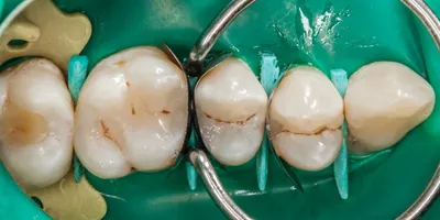 Средний кариес 47 зуба, выпадение пломбы 46 зуб | Примеры работ - фото до и  после