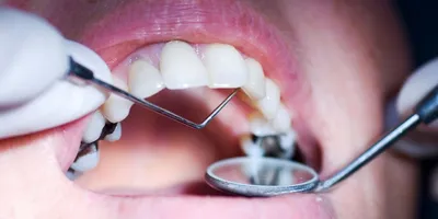 Лечение глубокого кариеса молочных зубов