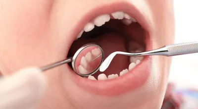 Лечение кариеса зубов в Томске