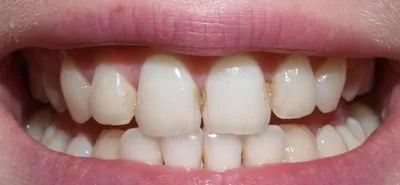 Кариес передних зубов: причины, лечение и профилактика