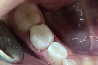 Лечение кариеса 36, 37 зуба - Стоматология Набережные Челны - DENTAL FORTE  \"Дентал Форте\"