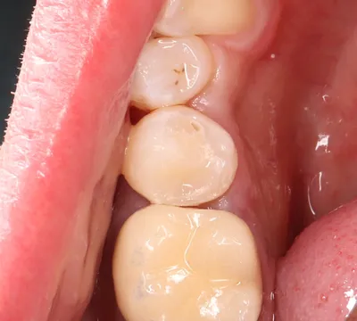 Лечение кариеса зубов: цены | Стоматологическая клиника «Улыбка» в Оренбурге