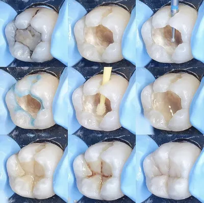 Кариес под пломбой . Отвалилась пломба