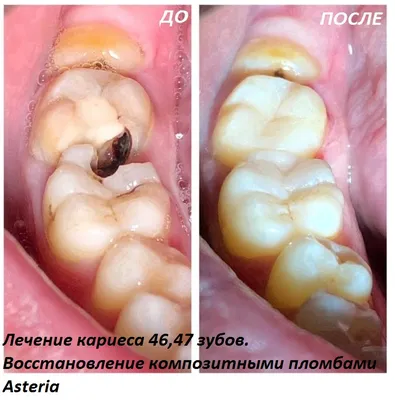 Кариес под пломбой, замена старых пломб, обращайтесь!