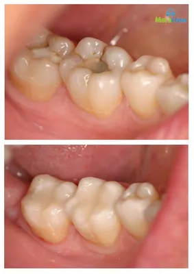Почему возникает кариес под пломбой? | Мегастом - сеть клиник