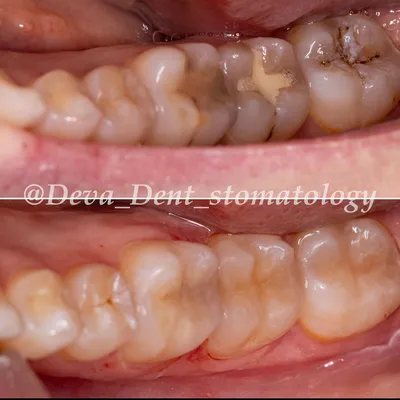 Кариес под пломбой – лечение кариеса и замена старых пломб