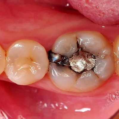 Вторичный кариес под пломбой... - Эстетическая стоматология | Facebook
