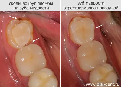 Больно ли лечить кариес с анестезией и без анестезии