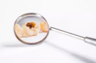 РАЗВИТИЕ КАРИЕСА ПОД ПЛОМБОЙ Вторичный кариес затрагивает здоровые ткани  зуба, которые находятся в непосредственной близости от… | Instagram
