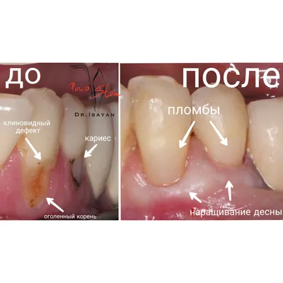 Пришеечный кариес: причины и лечение