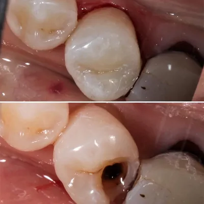 Ошибки в стоматологии: скрытый кариес под пломбой