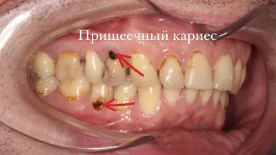 Пришеечный кариес зуба: лечение в современной стоматологии