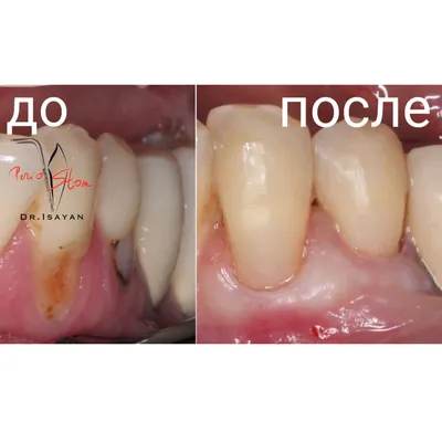 Лечение кариеса в Вуппертале. Лечить зубы от кариеса в Германии