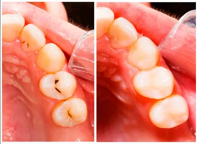 Кариес на передних зубах | Статьи стоматологии в Николаеве