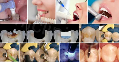 Лечение оголения шейки зуба