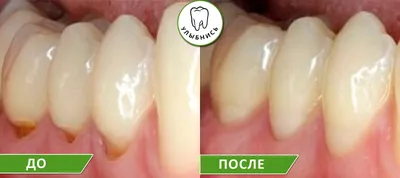 Лечение кариеса передних зубов: цена от 4000 руб за лечение пришеечного  кариеса в стоматологии НовоСмайл