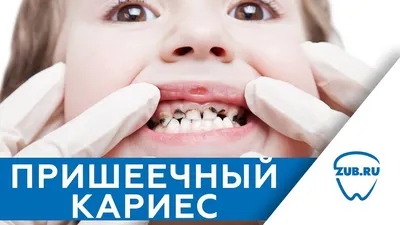 Пришеечный кариес (шейки зуба) — причины, симптомы и методы лечения