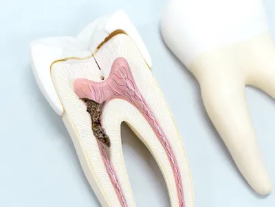 Больно ли лечить кариес на зубах