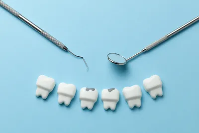 Кариес зубов: симптомы, стадии, способы лечения