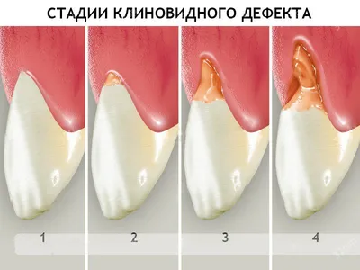 Оголение шейки зуба - причины и лечение