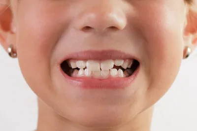 Кариес у детей: Лечения кариеса молочных зубов в Киеве