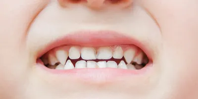 Лечение кариеса у детей: лечить кариес молочных зубов по ценам в  Ростове-на-Дону – Доктор Келлер