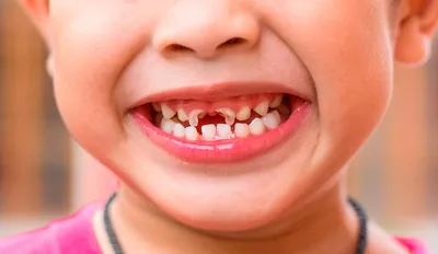 Платная детская стоматология: лечим кариес у детей