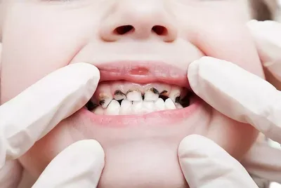 Лечение кариеса зубов у детей и взрослых. Доступная цена.