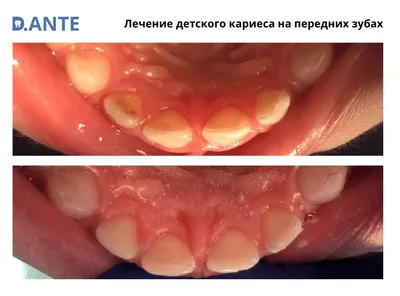 ᐈ Лечение кариеса Оболонь, цена на удаление кариеса в Киеве | Coral-Dent