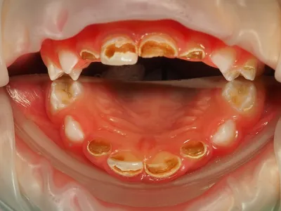 Кариес молочных зубов - Стоматология в Краснодаре