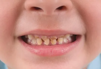 Какие виды и стадии кариеса зубов бывают, основные признаки и симптомы